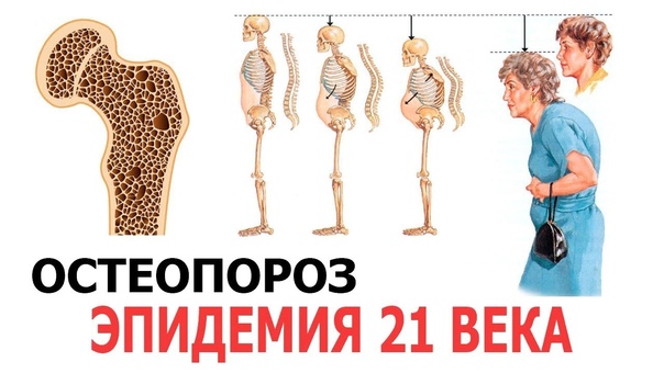 Профилактика остеопороза