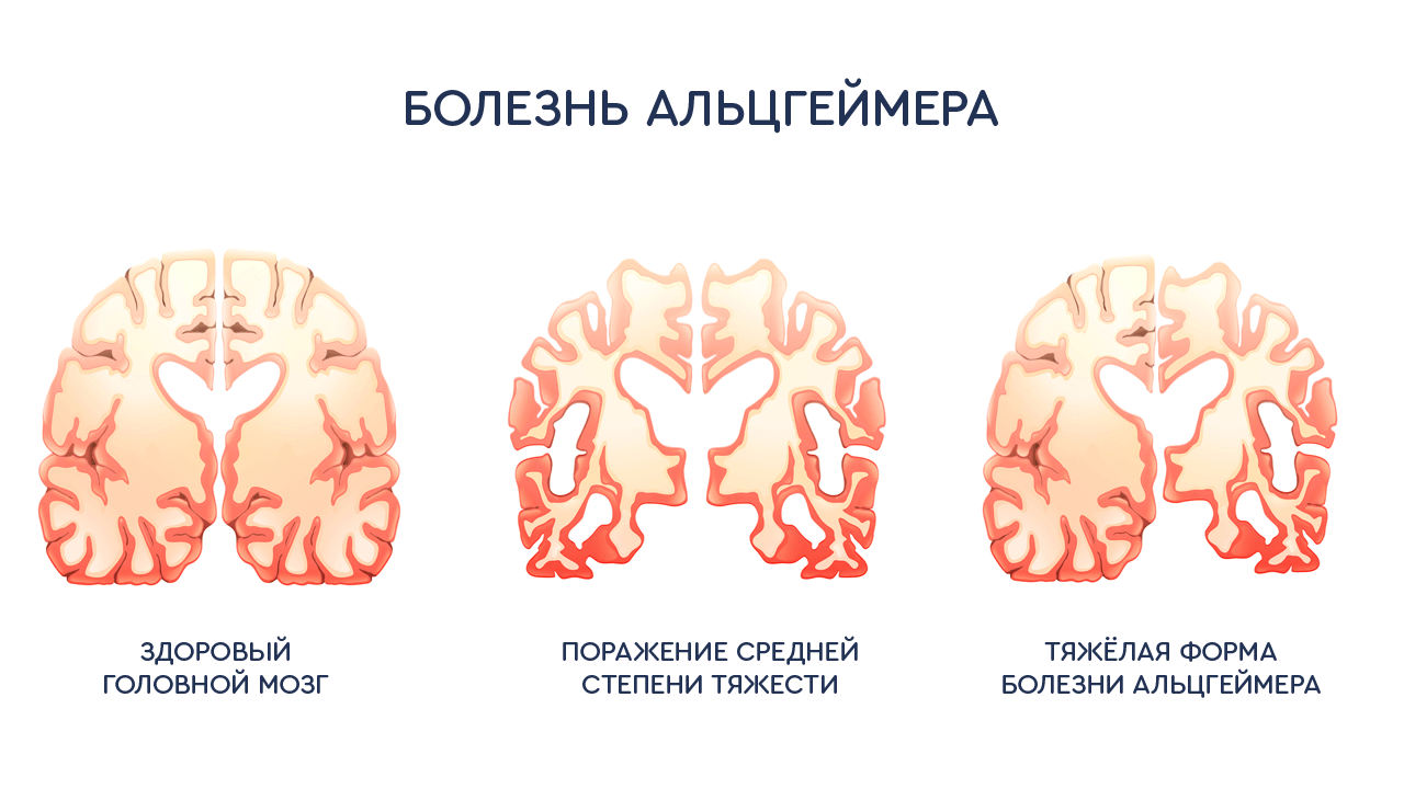 Болезнь Альцгеймера