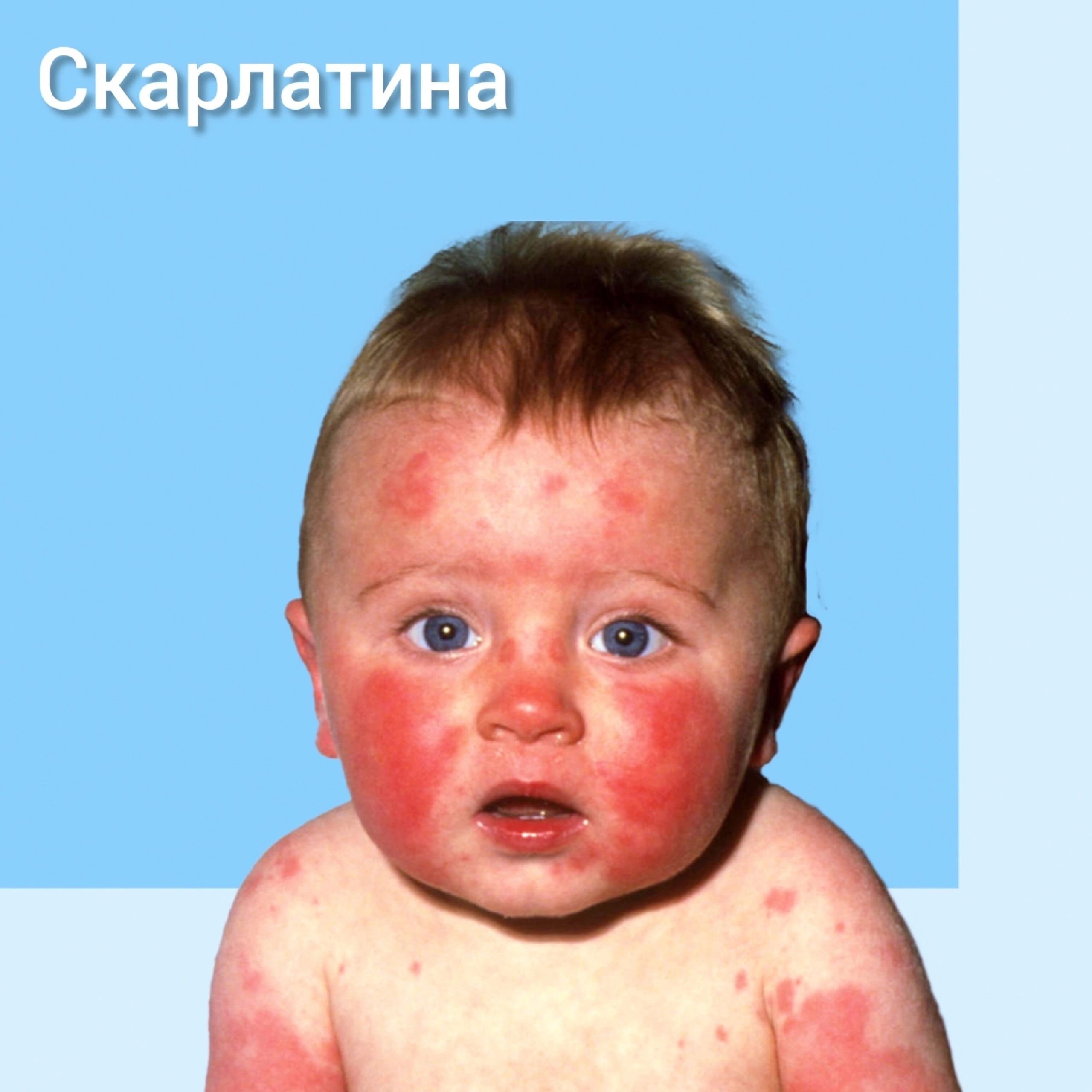 СКАРЛАТИНА СКАРЛАТИНА