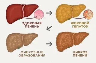 Жировой гепатоз 