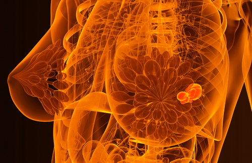 Как ожирение и проблемы с сердцем увеличивают риск рака молочной железы