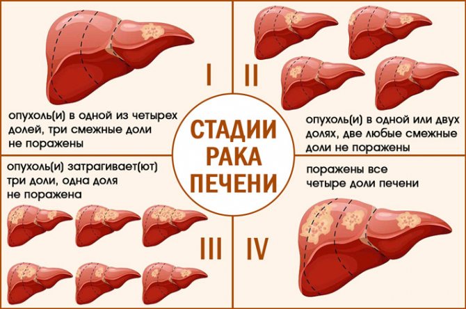 Симптомы рака печени